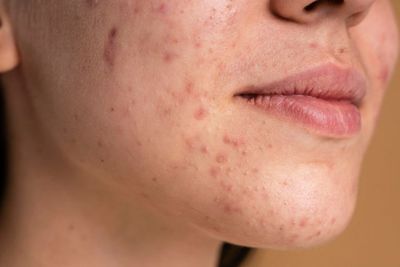 5 Skincare untuk Menghilangkan Bekas Jerawat, Terbukti Ampuh!
