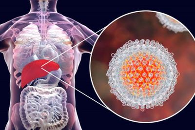 Penyebabnya Masih Misterius, Ini Perbedaan Hepatitis Akut dengan Hepatitis Biasa, Waspada!