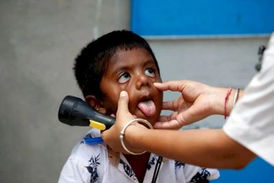 Pemerintah Lakukan Investigasi Kontak 3 kasus Hepatitis Akut pada Anak