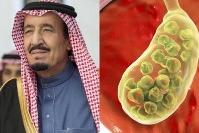 Mengenal Radang Kantong Empedu, Kondisi Kesehatan yang Dialami Raja Salman sampai Masuk RS