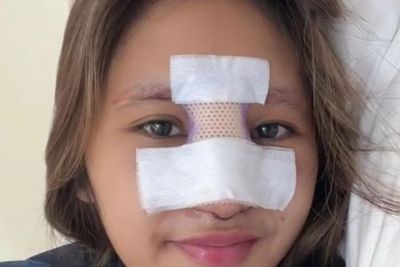 Putri Farida Nurhan Malah Infeksi Parah Usai Implan Hidung: Sakit!