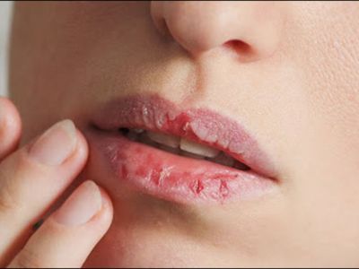 5 Cara Mengatasi Kerusakan Bibir Akibat Musim Panas dengan Bahan Alami