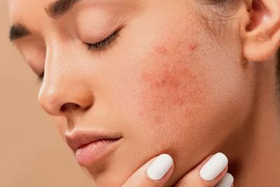Catat! 5 Perawatan Ini Bantu Meredakan Gangguan Kulit Eksim