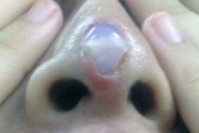 Gagal Implan, Hidung Wanita Ini Malah Keluar, Lihat Endingnya