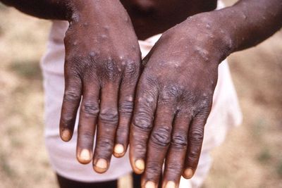 11 Negara yang Telah Melaporkan Kasus Cacar Monyet atau Monkeypox, Terbaru Australia