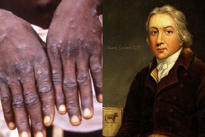 Sosok Dokter Edward Jenner, Penemu Vaksin Cacar Pertama di Dunia, Selamatkan Jutaan Nyawa