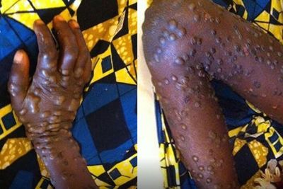 Gawat! Virus Cacar Monyet Sudah Sampai Israel, 12 Negara Telah Terinfeksi, Indonesia Aman?