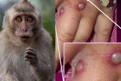Kemenkes Beri Peringatan soal Cacar Monyet, Langsung ke Dokter Jika Temukan Gejala Ini!