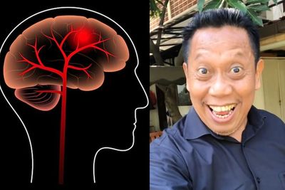 Tukul Arwana Lebih Sehat Usai Disuntik Vaksin Nusantara, Apa Pendarahan Otak Bisa Sembuh?