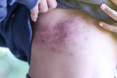 Kemenkes Sebut Cacar Monyet Bisa Menular Lewat Udara, Apa Saja Gejalanya?