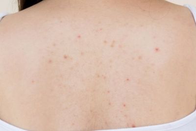 5 Tips Cegah Muncul Jerawat di Punggung, Nomor Terakhir Penting Banget 