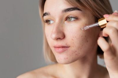 Kulit Berjerawat dan Komedo Tak Kunjung Sembuh? Beli Skincare dengan 6 Kandungan Ini