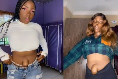 Viral Pusar Seorang Wanita Menonjol Keluar, Diduga Mengidap Hernia Umbilikalis, Apa Itu?