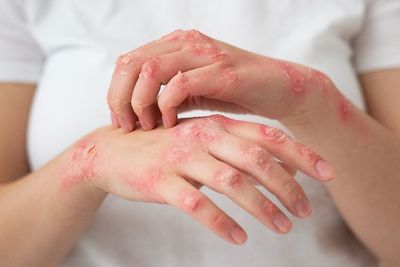 Monkeypox Meningkat, Ini Gejala Unik Cacar Monyet Menurut Pakar yang Harus Diwaspadai