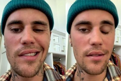 Justin Bieber Idap Ramsay Hunt Syndrome hingga Wajahnya Lumpuh Sebelah, Apa Penyebabnya?
