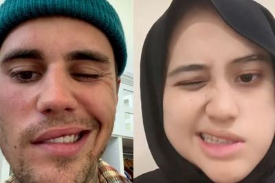 Viral, Cewek Curhat Wajah Lumpuh Sebelah Seperti Justin Bieber, Ternyata Idap Bell s Palsy