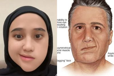 Diidap Wanita Cantik Ini, Bell s Palsy Ternyata Rentan Dialami Ibu Hamil & Pesien Diabetes