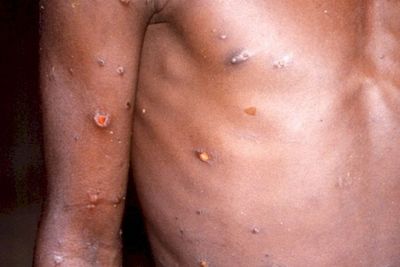Virus Cacar Monyet Ditemukan di Air Mani, Benarkah Monkeypox Ditularkan Lewat Seksual?