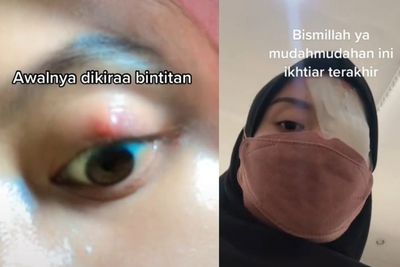 Viral Wanita Curhat Alami Benjolan di Mata, Dikira Bintitan Ternyata Kena Penyakit Ini