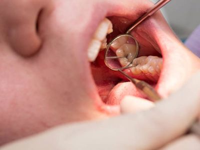 Gara-gara Gigi Berlubang, Pria Ini Pipinya Bengkak, Bernanah, hingga Meninggal Dunia