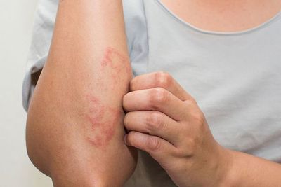 8 Jenis Ruam Merah pada Kulit Dewasa dan Anak-Anak serta Bentuknya