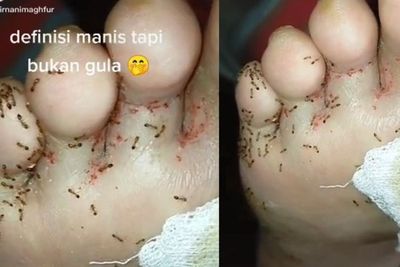 Penampakan Luka Diabetes yang Dikerumuni Semut, Benarkah Rasanya Manis?