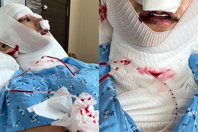 Lucinta Luna Bersimbah Darah Usai Potong Leher Buang Khodam, Ini Bahaya Oplas Berulang!