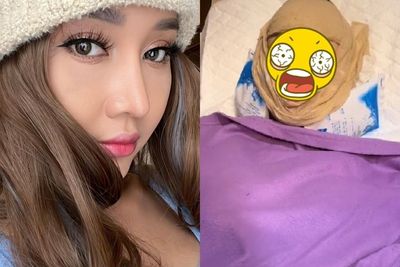Ngeri! Wajah Lucinta Luna Bengkak dan Membiru Usai Operasi Gergaji Rahang, Susah Melek