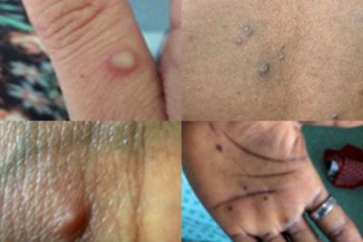 Gawat! Pasien Cacar Monyet Berpotensi Menularkan Virus yang Cukup Tinggi