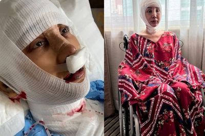 Usai Potong Leher dan Tulang Ekor, Lucinta Luna Bakal Oplas Ganti Kulit, Ini Risikonya!