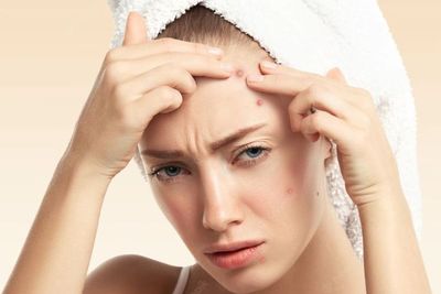 Muncul Jerawat Bisa Bikin Orang Kena Mental, Kok Bisa?