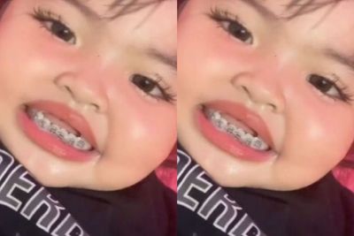 Viral Gadis Kecil Pakai Behel, Mom Wajib Tahu Usia Pemasangan Behel pada Anak