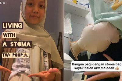 Hidup dengan Kantong Stoma untuk Keluarkan Feses, Gadis Ini Banjir Semangat dari Netizen