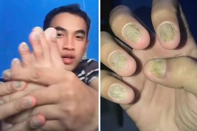 Ngeri! Kuku Pria Ini Rusak Karena Pakai Spidol Seperti Cat Kuku