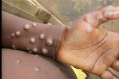Anak Berusia 4 Tahun di Jerman Terpapar Cacar Monyet, Tertular dari Orangtuanya