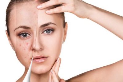 Tips dan Trik Makeup Tutupi Jerawat agar Terlihat Flawless, Nomor 4 Kuncinya!