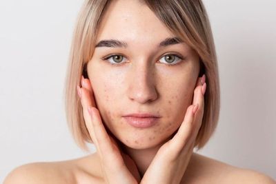 3 Resep Skincare untuk Mengatasi Masalah Kulit Kusam, Cobain Deh Gen Z!