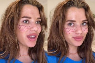 Ngeri! Pipi Wanita Ini Penuh Luka Usai Nekat Bikin Tato Freckles Sendiri Pakai Jarum Jahit