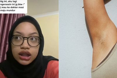 Gegara Deodoran Ketiak Wanita Ini Bengkak sampai Harus Operasi, Sempat Dikira Bisul