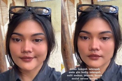 Wanita Ini Kena Bell s Palsy Gegara Sering Pakai Kipas Angin dan AC, Sebagian Wajah Lumpuh