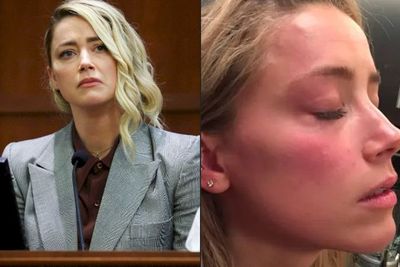 Email Amber Heard Bocor, Foto Luka Memar saat di Persidangan Diduga Palsu