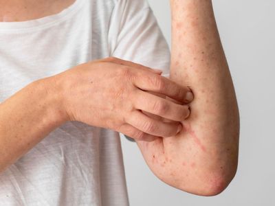 Cacar Monyet Tidak Menular Selama Belum Bergejala, Masa Inkubasinya Mulai 21 Hari