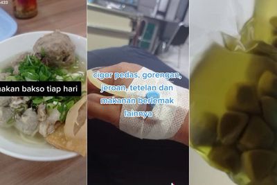 Kisah Wanita Idap Batu Empedu Usai Tiap Hari Makan Bakso dan Minuman Bersoda