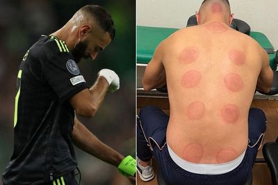 Benzema Pamer Punggung Habis Bekam, Siap Comeback Bikin Lawan Terancam