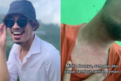 Cowok 26 Tahun Ini Kena HIV Lewat Jarum Suntik, Kini Harus Minum Obat Seumur Hidup