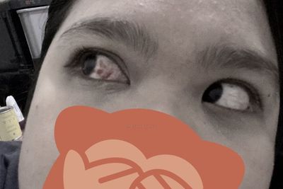 Heboh Pembuluh Darah Mata Pecah Akibat Bersin Terlalu Kencang, Ini Penyebab Lainnya!