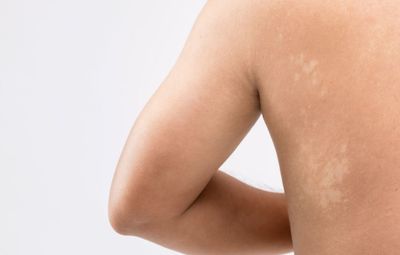 5 Cara Menghilangkan Panu dengan Cepat secara Alami, Ampuh!
