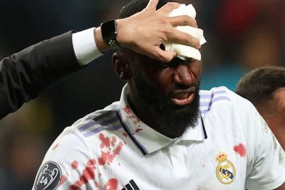 Dijahit di Ruang Ganti, Begini Cara Tim Medis Tangani Kepala Rudiger yang Bocor