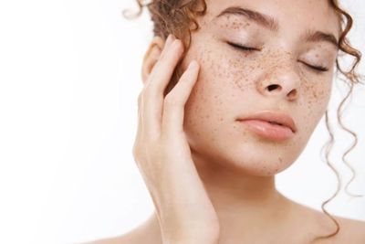 Apa Itu Dark Spot? Gen Z Bisa Terancam Kena Masalah Kulit Ini Loh