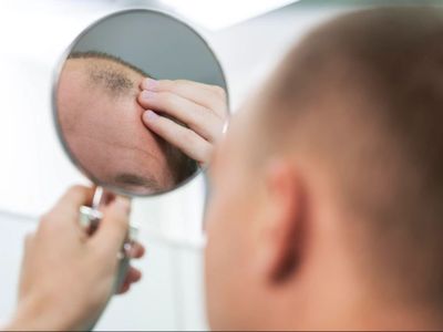 5 Penyebab Kebotakan yang Perlu Kamu Sadari, Stress Salah Satunya!